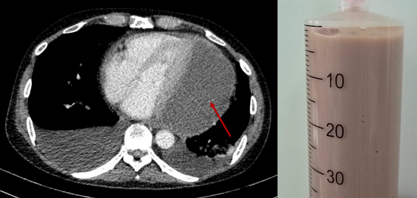 Bệnh viện Nhân dân 115 điều trị thành công ca tràn mủ màng ngoài tim hiếm gặp