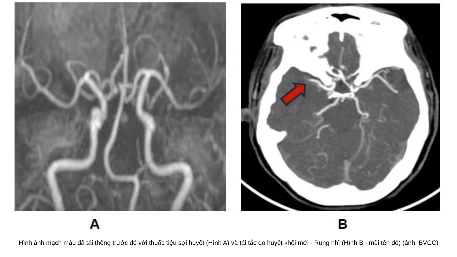 Cấp cứu thành công ca đột quỵ tái phát nhờ tái thông mạch máu khẩn cấp