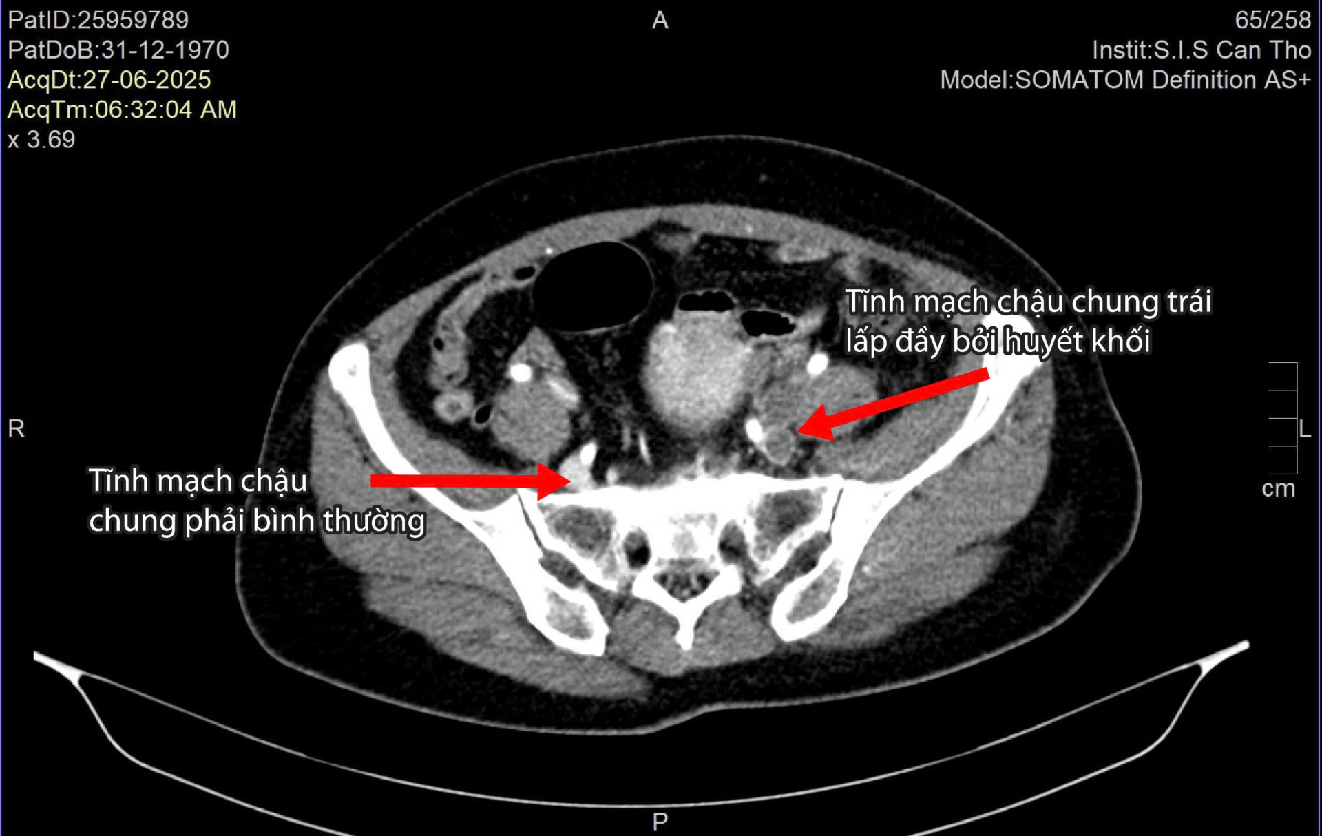 Chân trái sưng phù như chân voi, người phụ nữ bị nghi ngờ đang mang thai