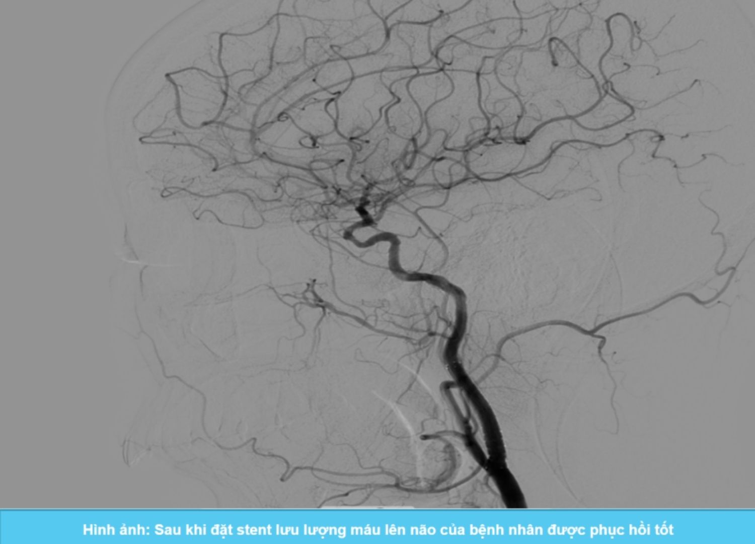 Đặt stent thành công cho bệnh nhân hẹp động mạch cảnh trong kèm bất thường giải phẫu hiếm gặp Bovine Arch