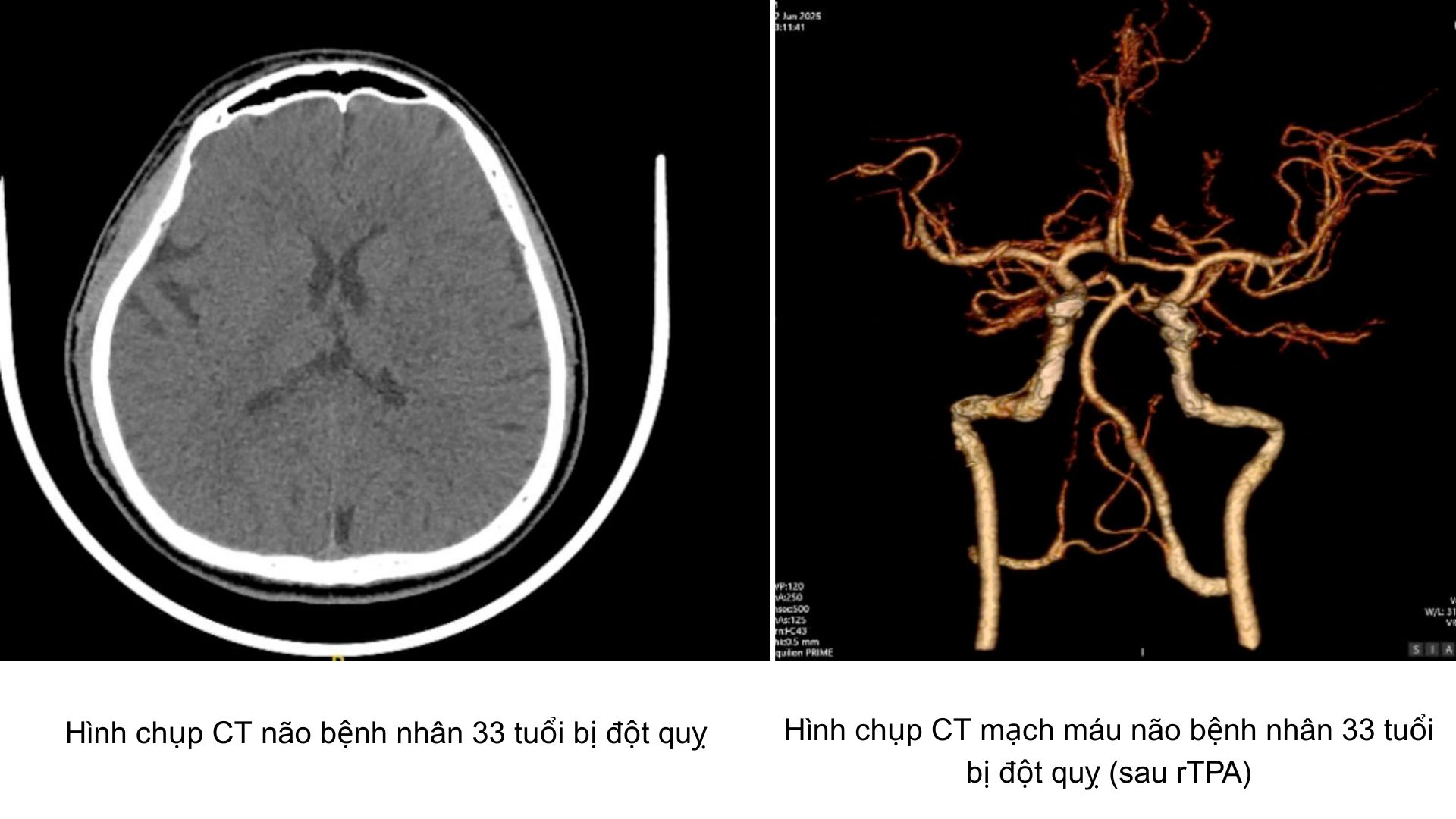 Nam thanh niên 33 tuổi khỏe mạnh đột ngột đột quỵ