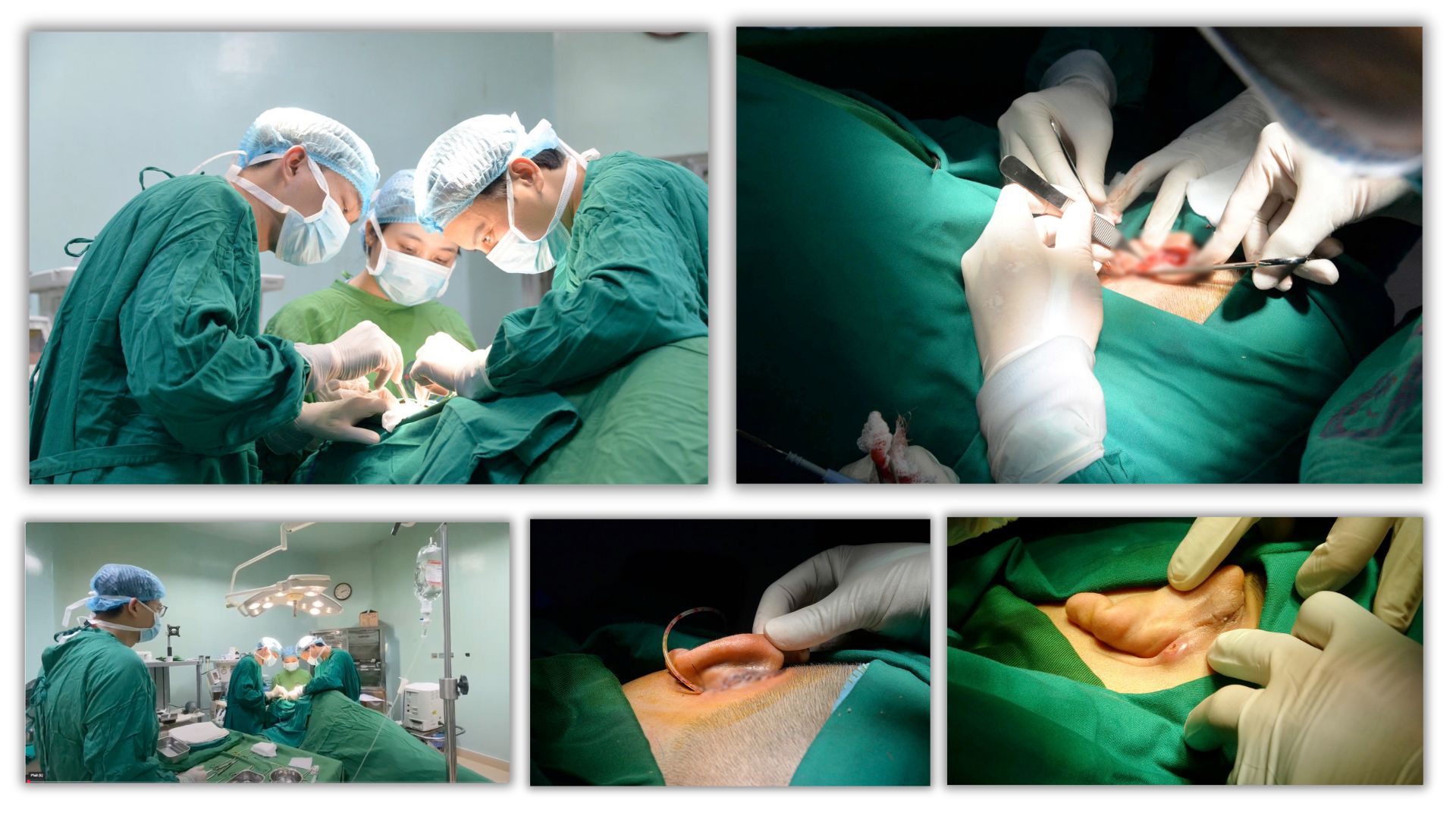 Phẫu thuật tạo hình vành tai cho bệnh nhân K giáp, đái tháo đường, tăng huyết áp