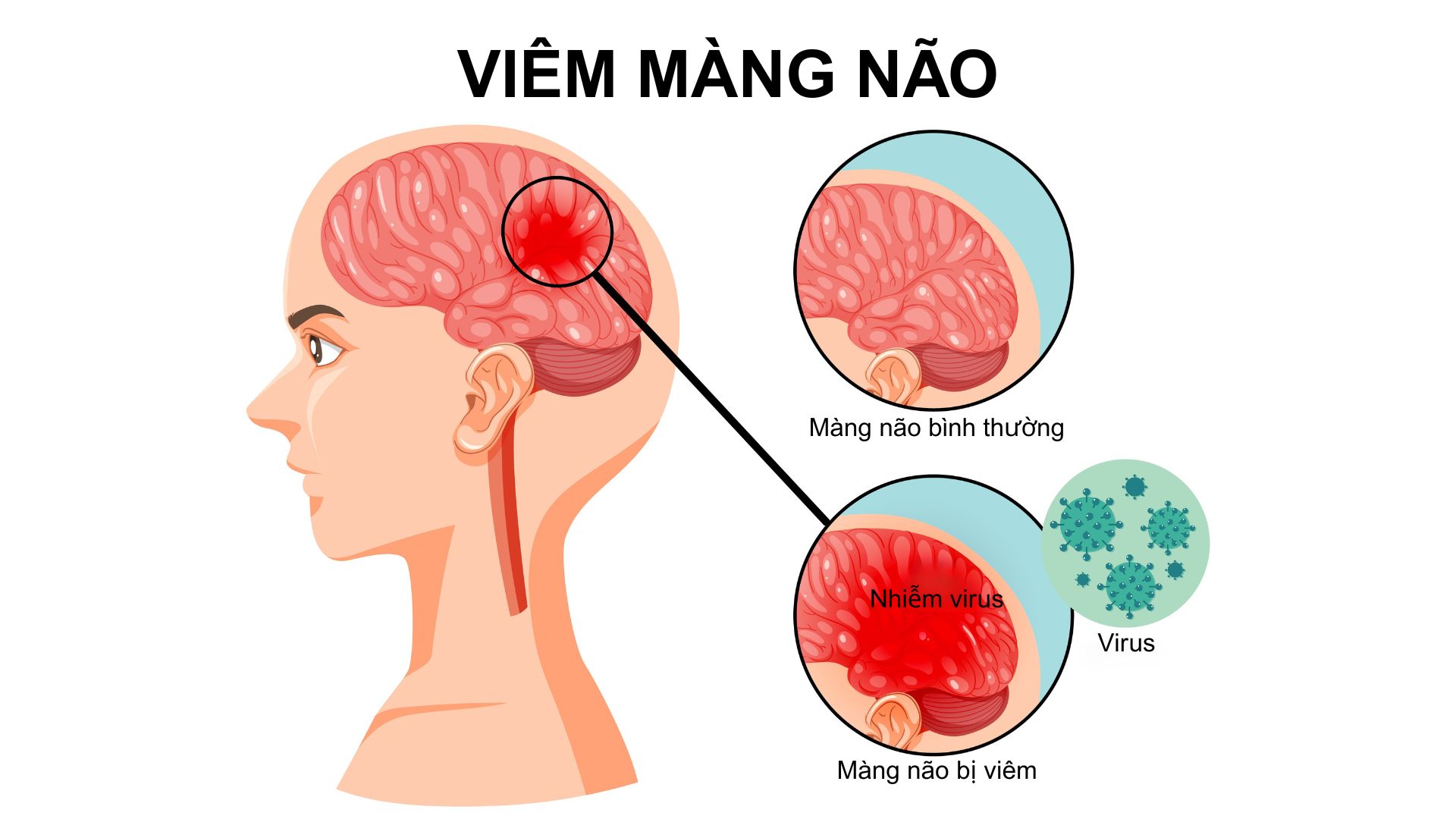 Cứu sống bệnh nhân viêm màng não mủ trên nền đái tháo đường, tăng huyết áp, rối loạn mỡ máu