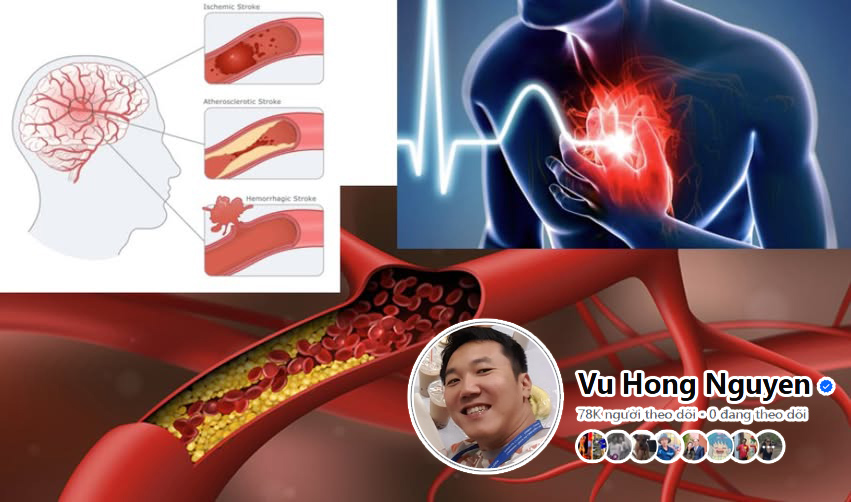 TS Nguyễn Hồng Vũ: Mạch máu khỏe – nền tảng sống còn của não và tim