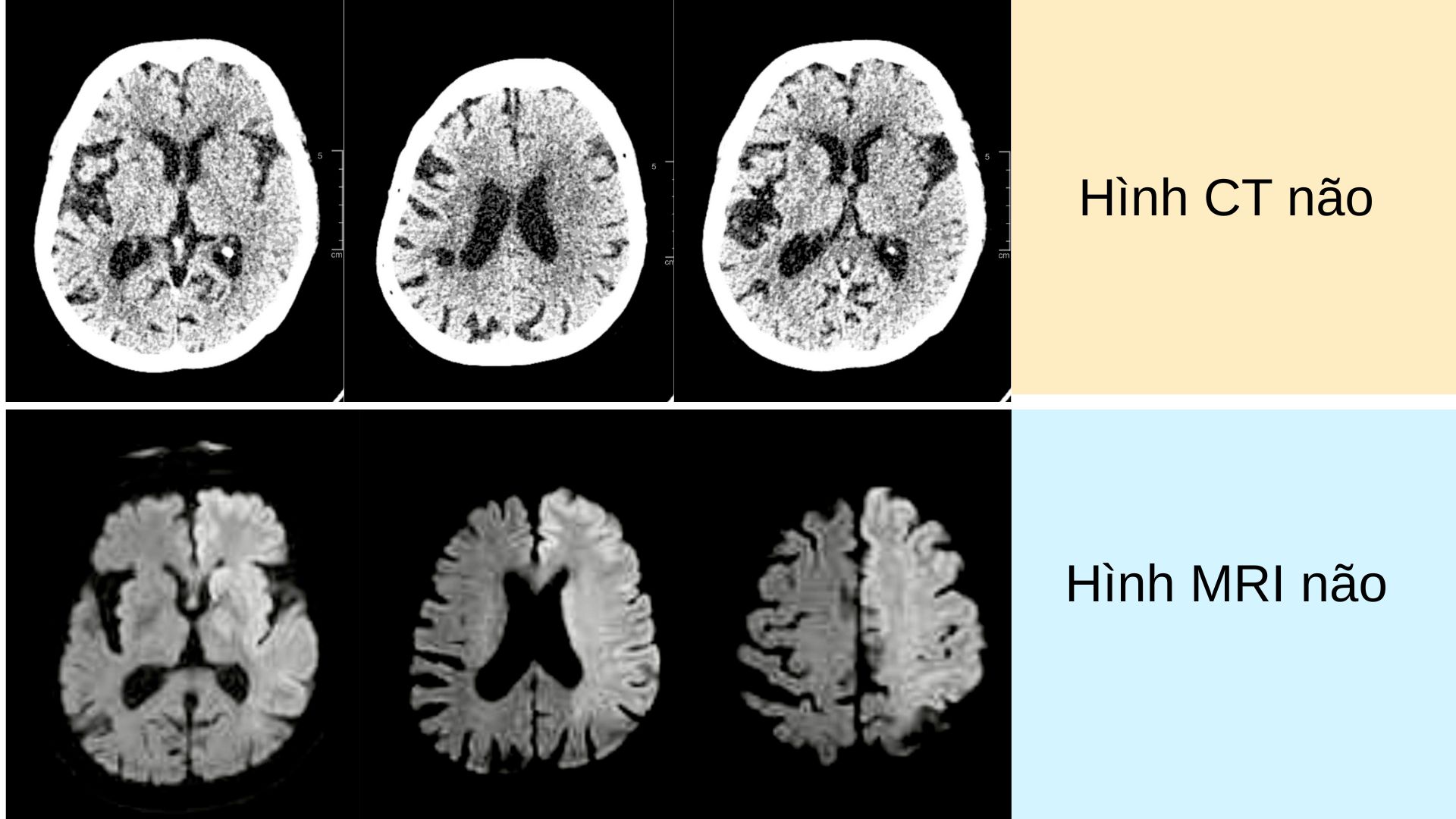Tiêu chuẩn hình ảnh học – Yếu tố sống còn trong quyết định điều trị đột quỵ cấp