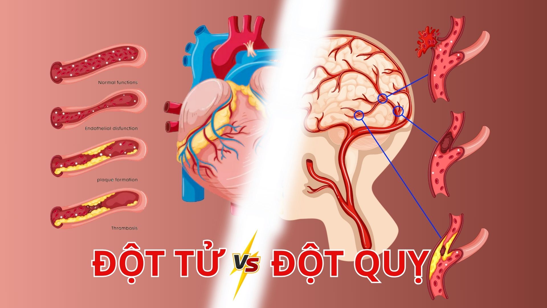 Đột tử do bệnh tim có phải là đột quỵ?