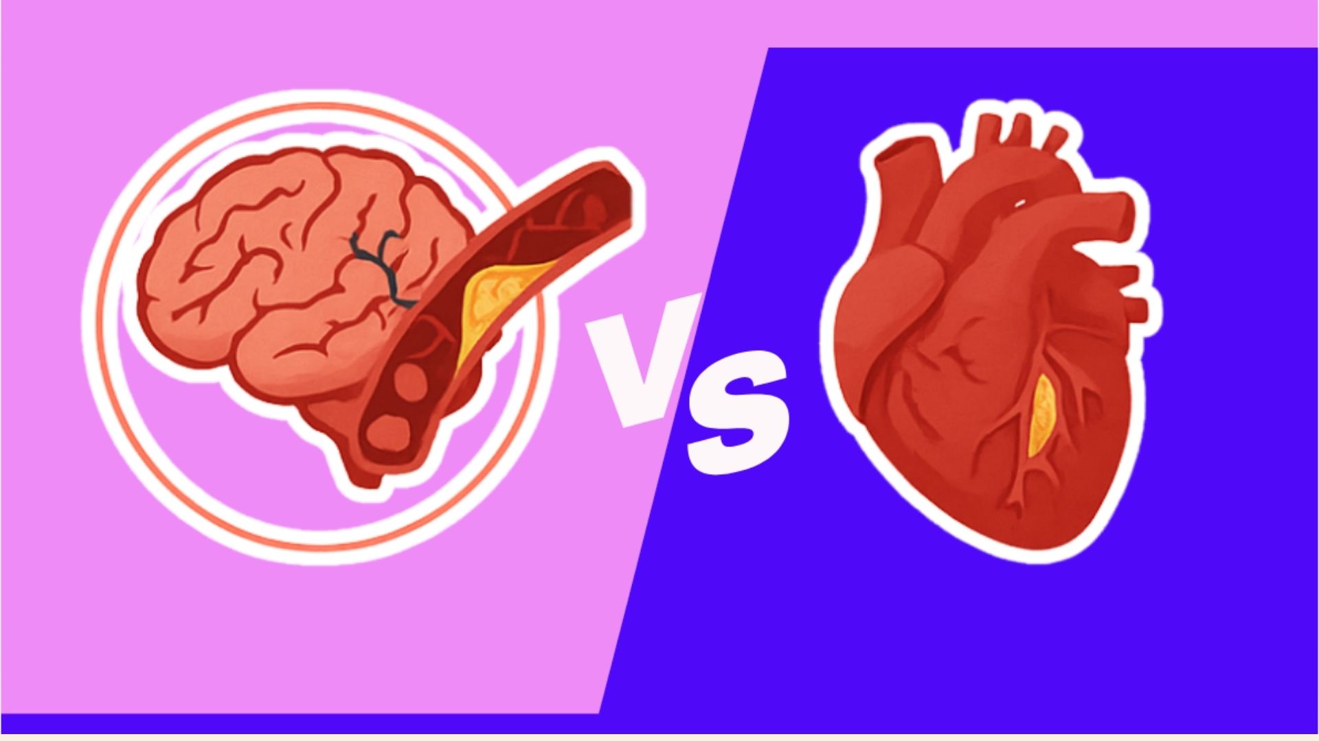 Đột quỵ – nhồi máu cơ tim, điểm chung và khác biệt