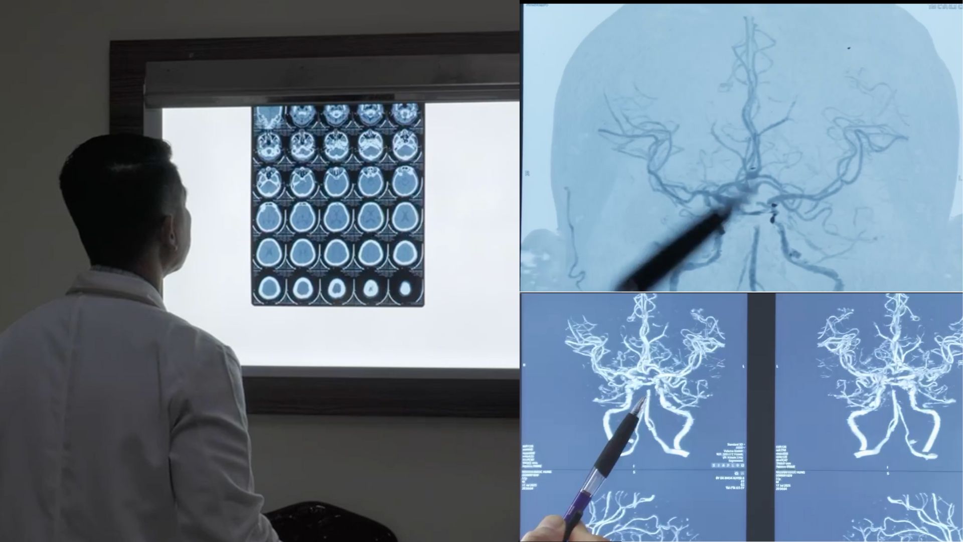 Suýt mất mạng vì vợ chích máu theo clip trên mạng khi chồng bị đột quỵ