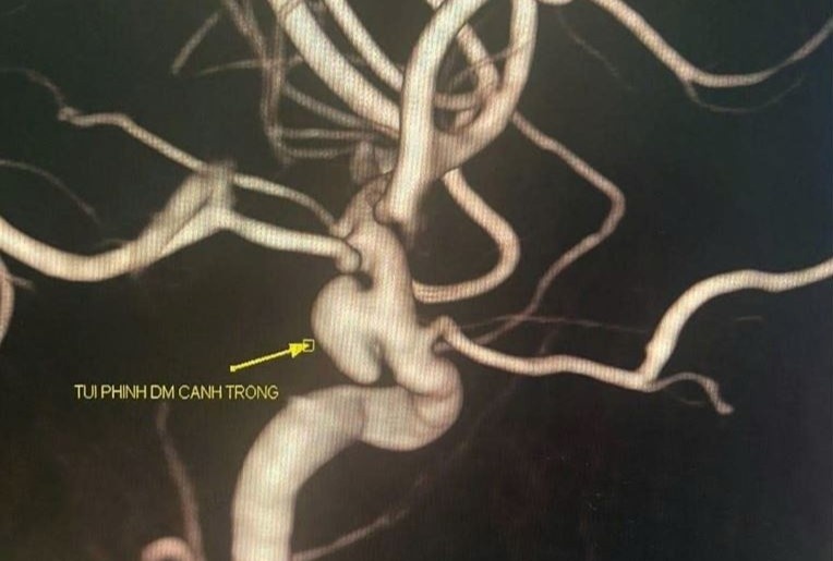 Đau đầu, run tay thoáng qua, cô gái trẻ phát hiện “quả bom nổ chậm” trong não