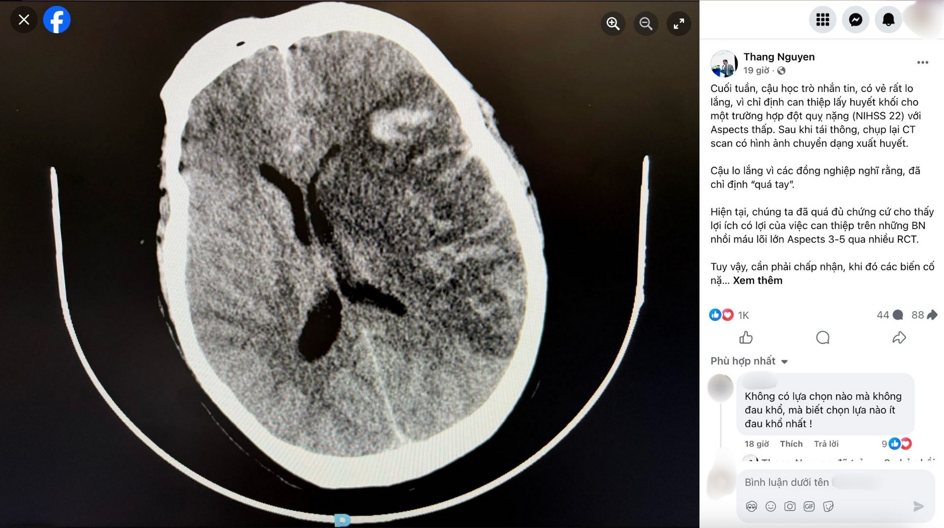 PGS Nguyễn Huy Thắng: “Hãy cho bệnh nhân đột quỵ nặng một cơ hội, cho dù nhỏ”