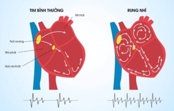 Rung nhĩ có chữa khỏi được không?