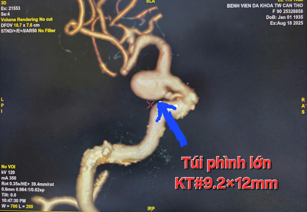 Cần Thơ: Can thiệp thành công túi phình mạch não cụ bà 90 tuổi