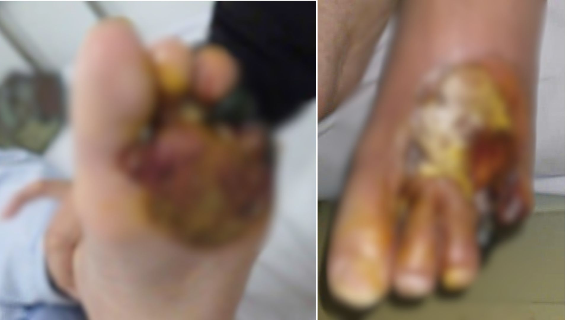 Bỏng, loét, cắt cụt – hậu quả từ thói quen sưởi chân của người đái tháo đường