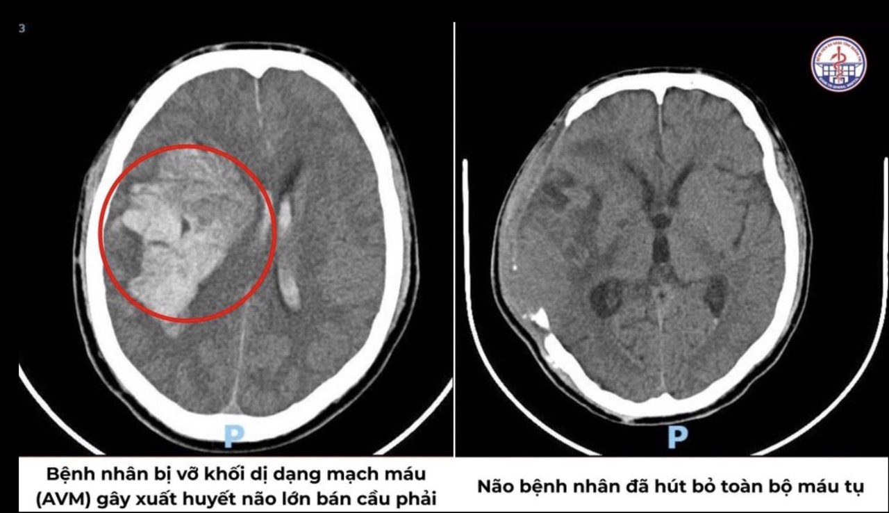Đột quỵ xuất huyết não ở tuổi 35