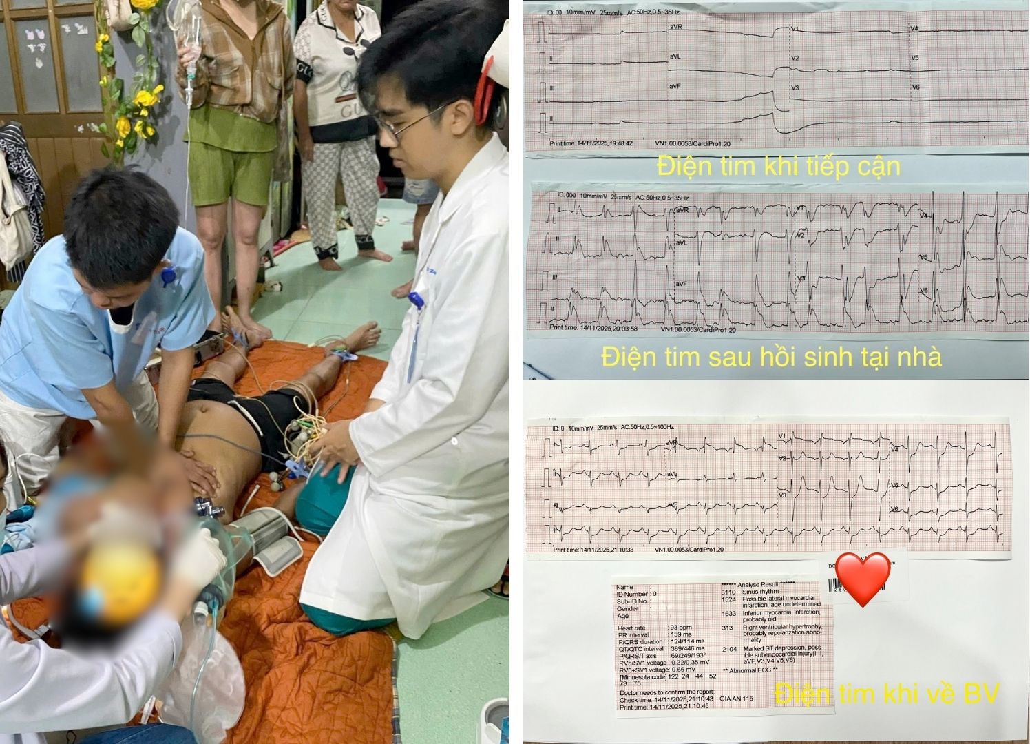 Sai lầm khi cấp cứu tại nhà khiến bệnh nhân ngưng tim, phù não nặng
