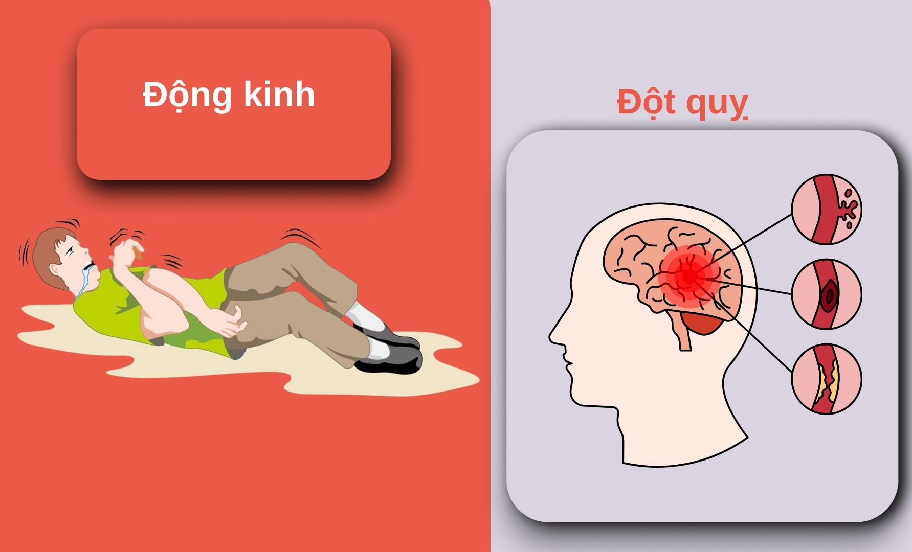 Phân biệt đột quỵ và động kinh