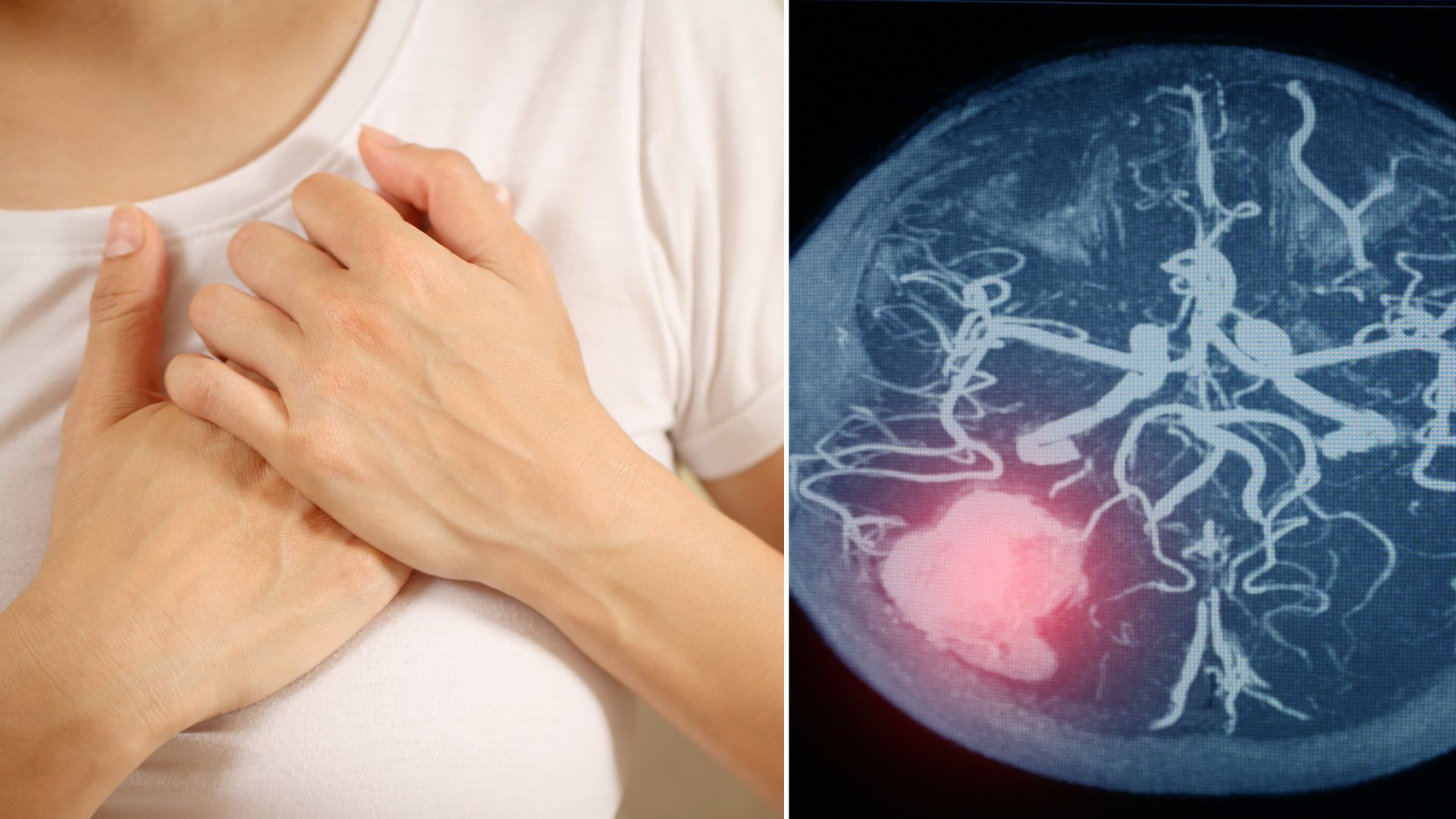 Không phải túi phình nào cũng phải mổ: Chuyên gia chỉ rõ dấu hiệu nguy hiểm cần can thiệp