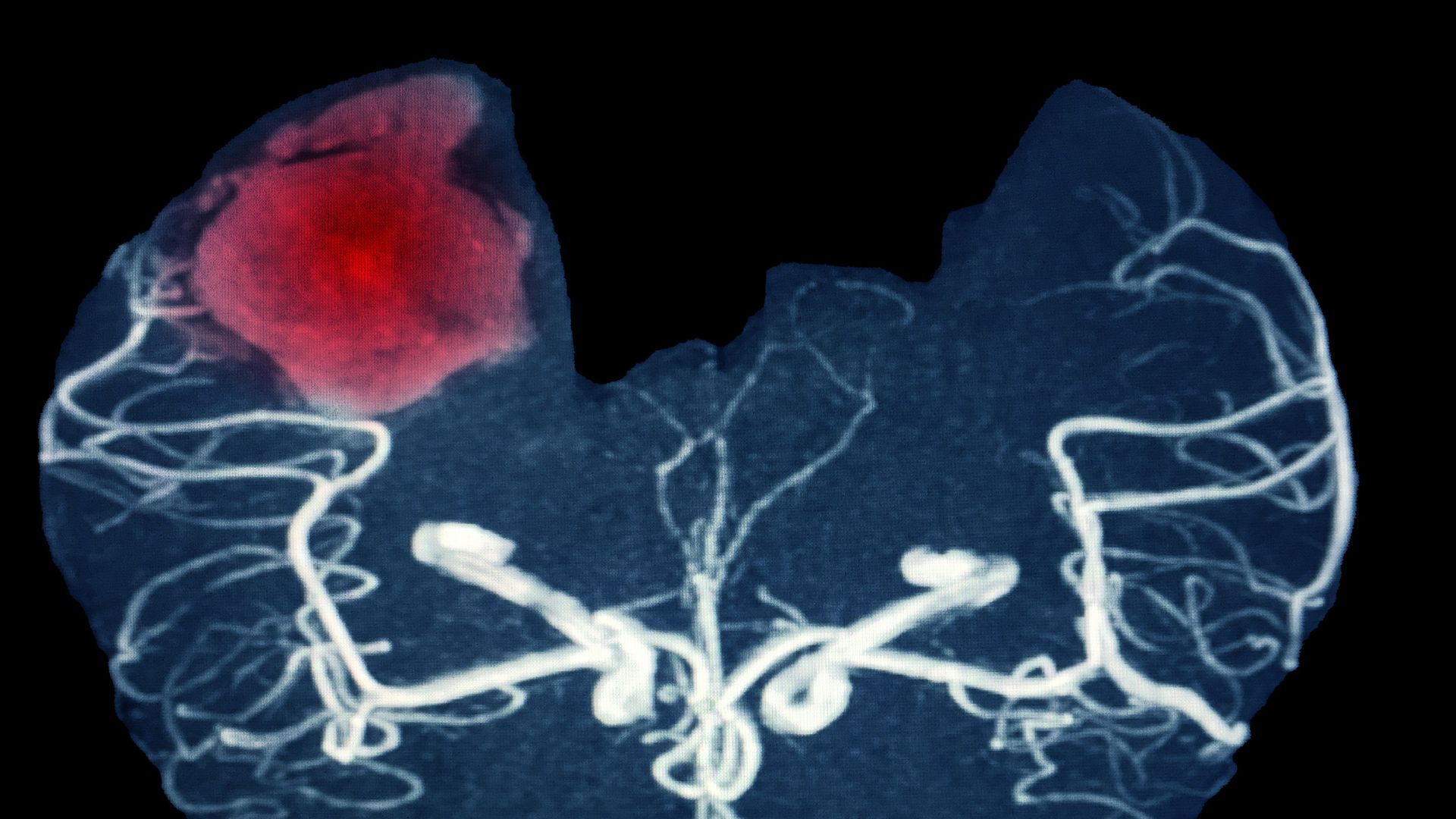 Dự phòng xuất huyết não mùa lạnh