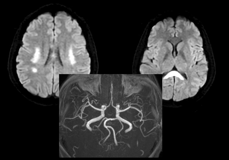 Đột quỵ ở phụ nữ sau IVF: Khi can thiệp sinh sản trở thành yếu tố nguy cơ tiềm ẩn