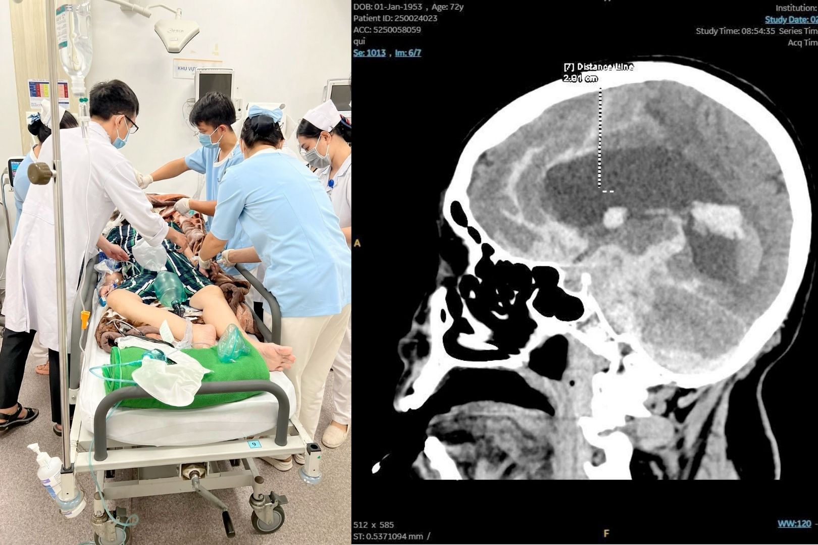 Xuất huyết não vì tự ý uống thuốc kháng đông theo toa cũ