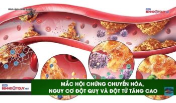 Mắc hội chứng chuyển hóa, nguy cơ đột quỵ và đột tử tăng cao