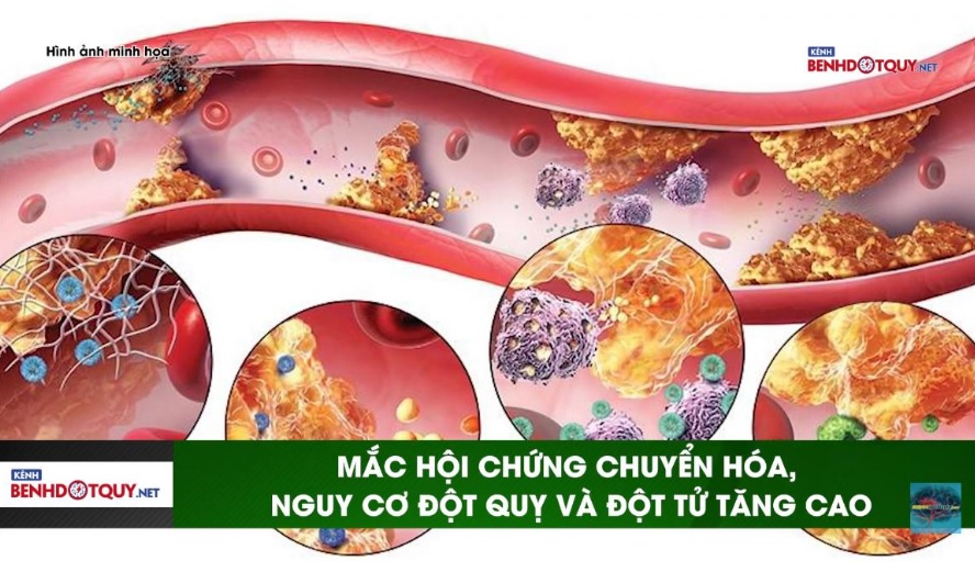 Mắc hội chứng chuyển hóa, nguy cơ đột quỵ và đột tử tăng cao