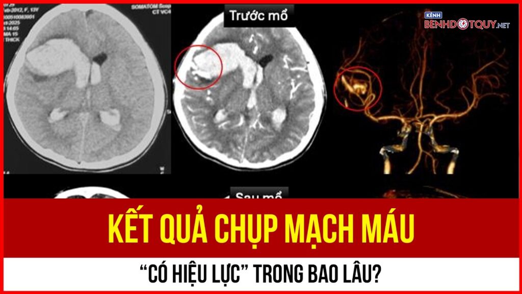 https://benhdotquy.net/ket-qua-chup-mach-mau-co-hieu-luc-trong-bao-lau/