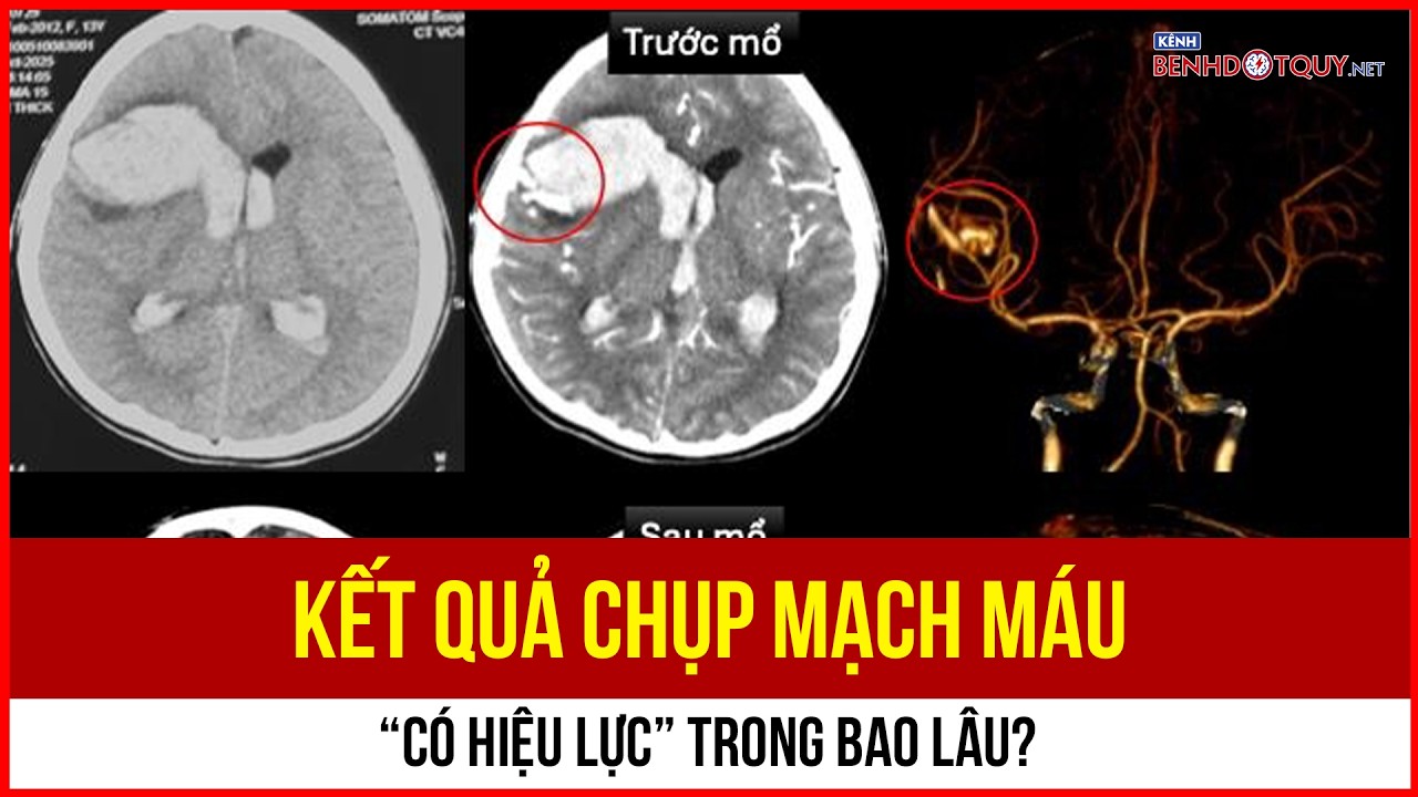 Kết quả chụp mạch máu “có hiệu lực” trong bao lâu?