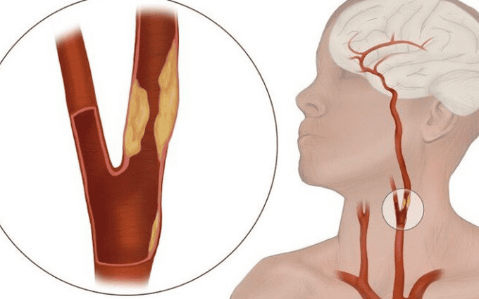 Sau can thiệp mạch cảnh, có cần dùng thuốc hỗ trợ không?